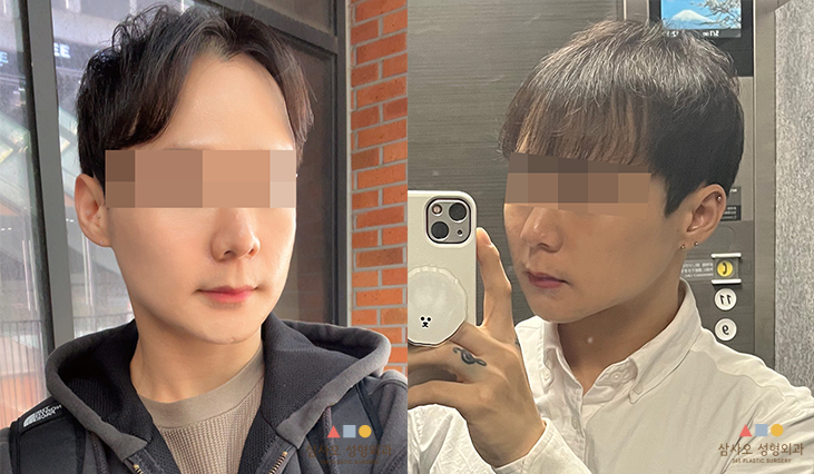 수술 후