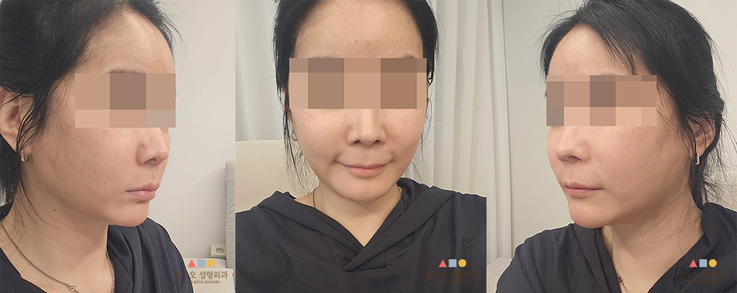 수술 후