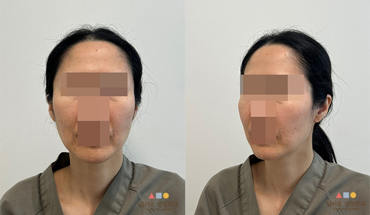 수술 전