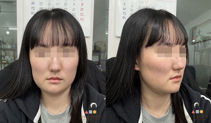 수술 후