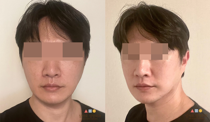 수술 후
