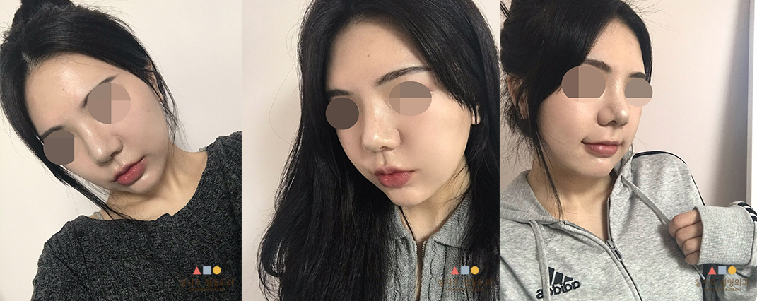 수술 후