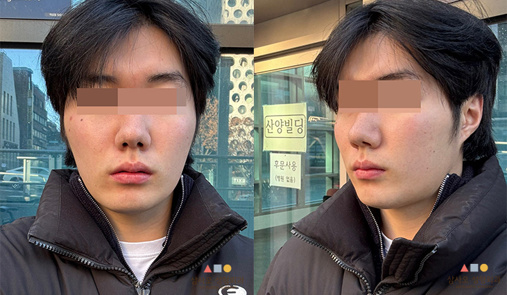 수술 전
