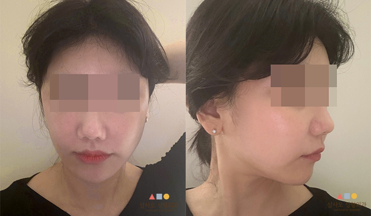 수술 후