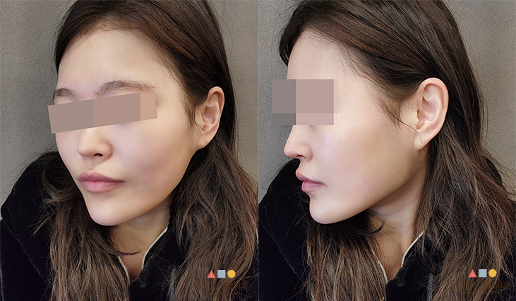 수술 전