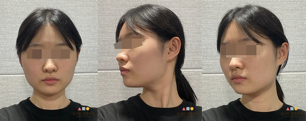 수술 전