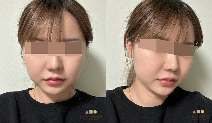 수술 후