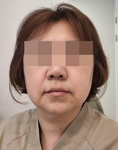 수술 전