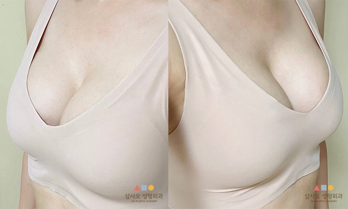 수술 후