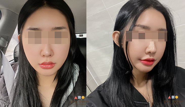 수술 후