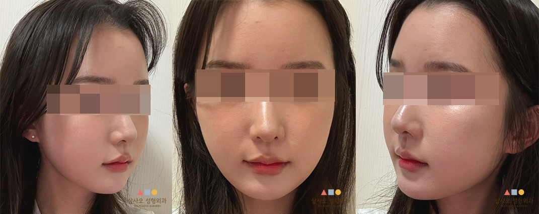 수술 후
