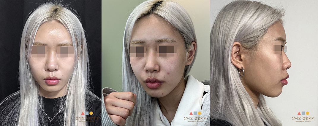 수술 전
