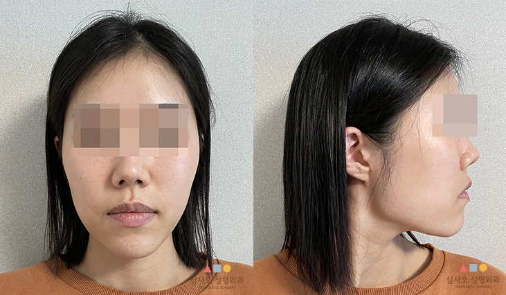 수술 전