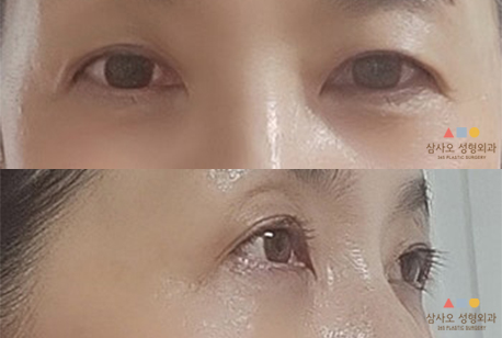수술 후