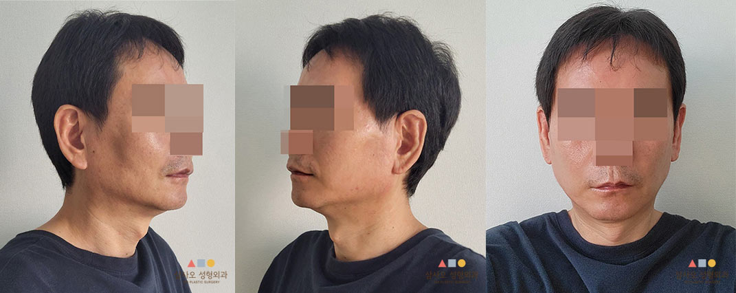 수술 후