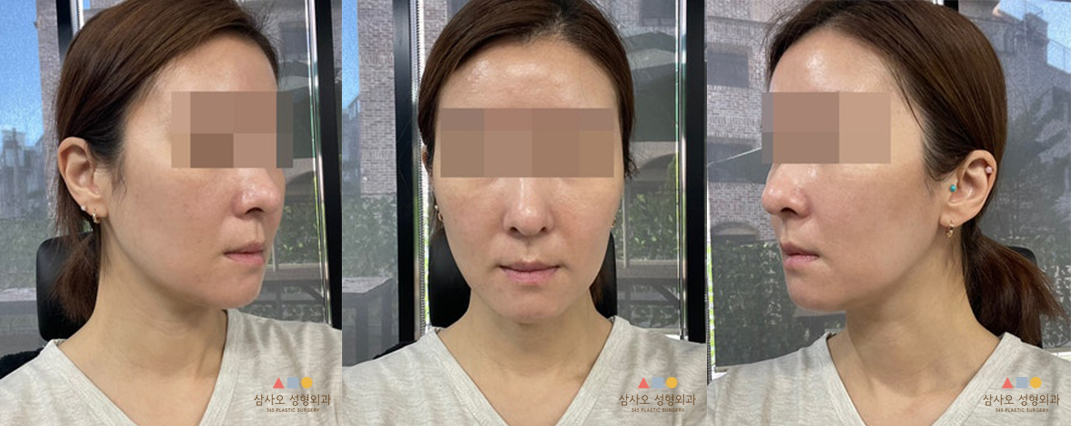 수술 후