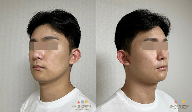 수술 후