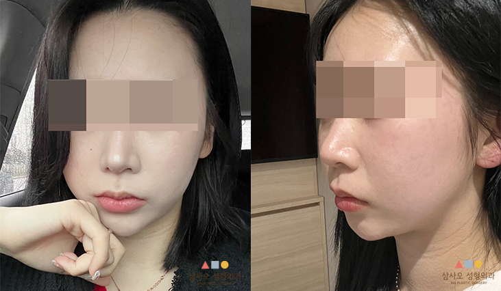 수술 후