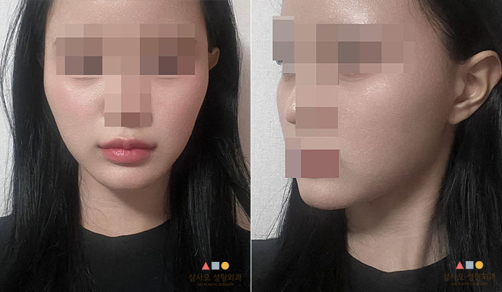 수술 전