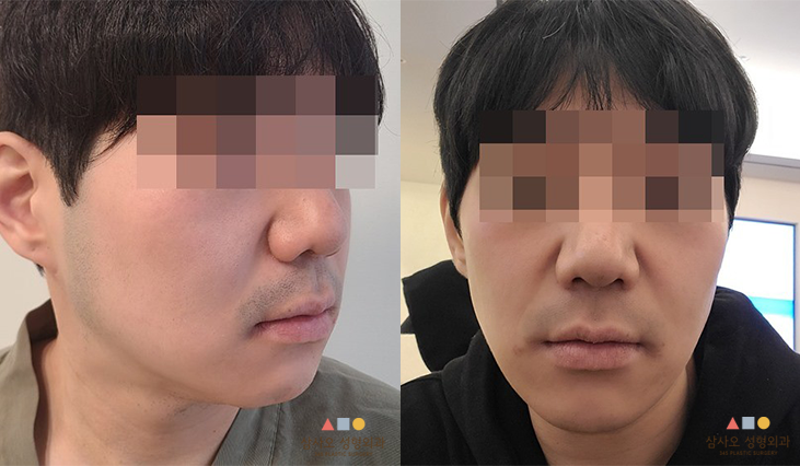 수술 전