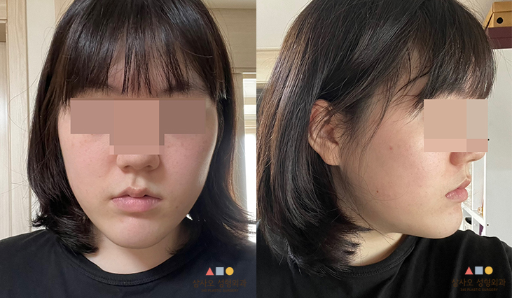 수술 전