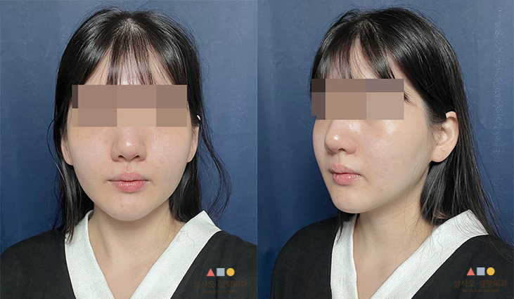 수술 후