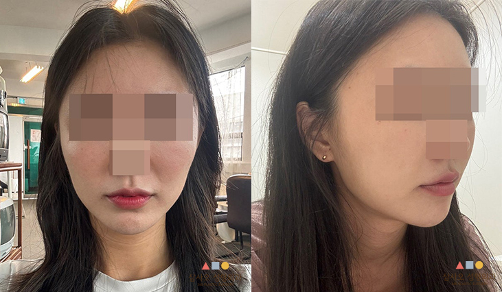 수술 전