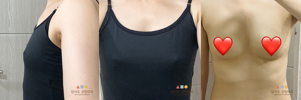 수술 전