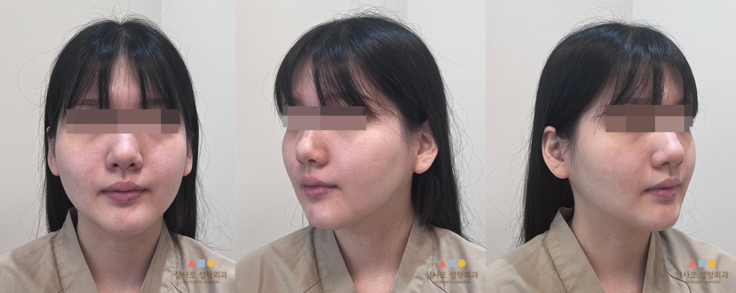 수술 전