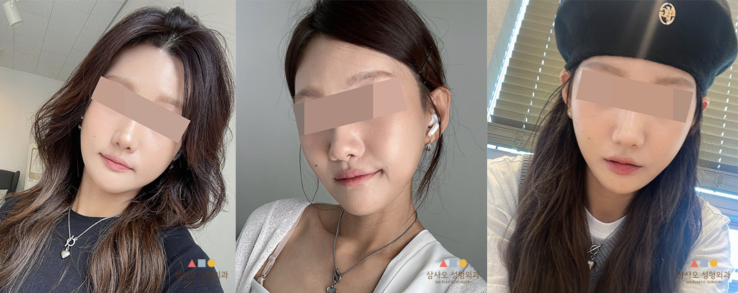 수술 후