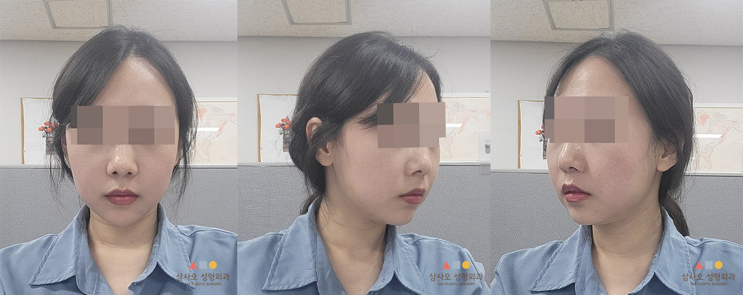수술 후