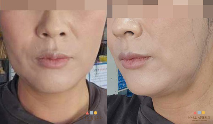 수술 전