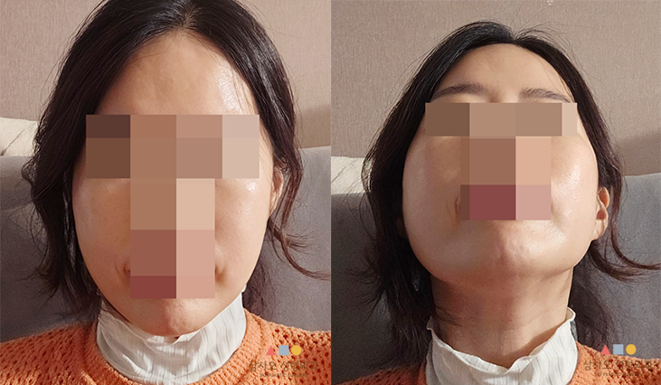수술 후