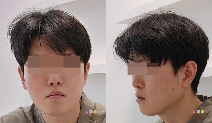 수술 전