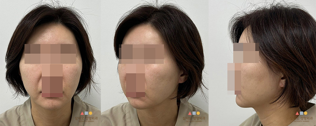 수술 전