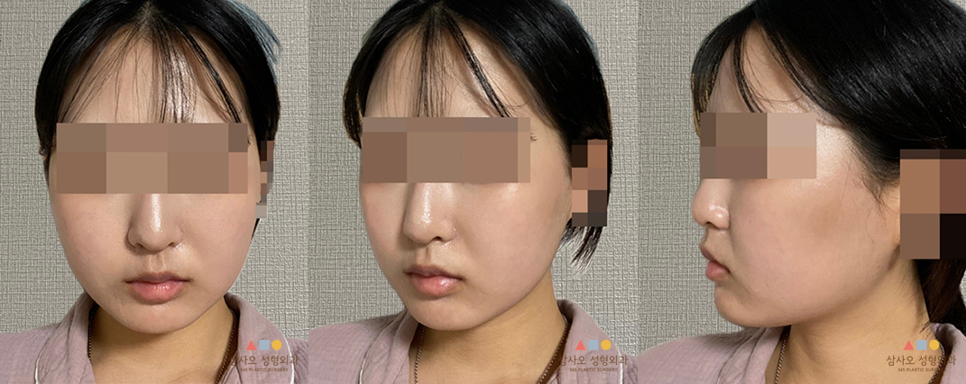 수술 후