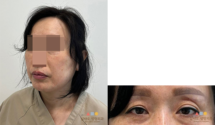 수술 전