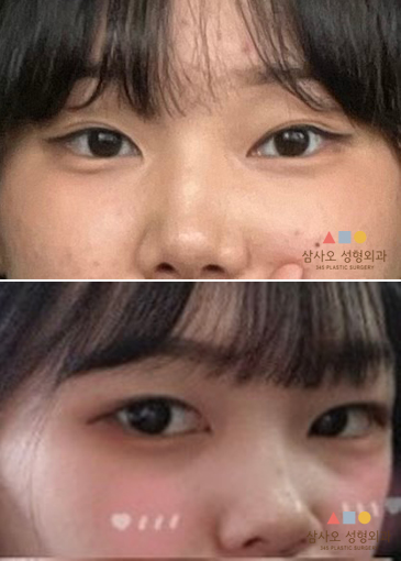 수술 전