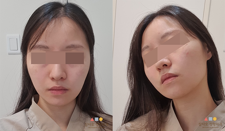 수술 전