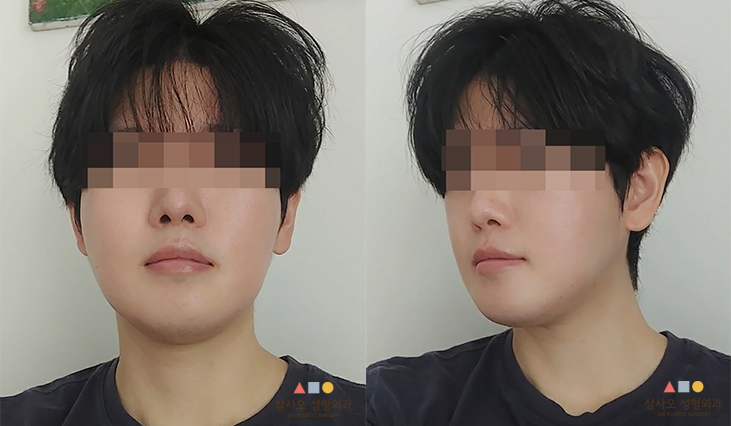 수술 후