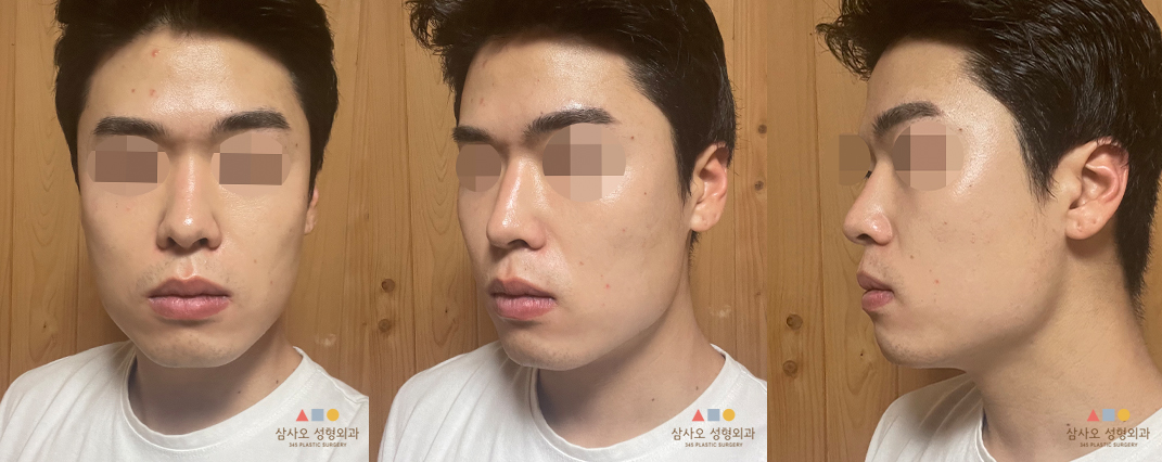 수술 전