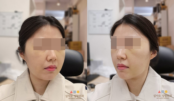 수술 후