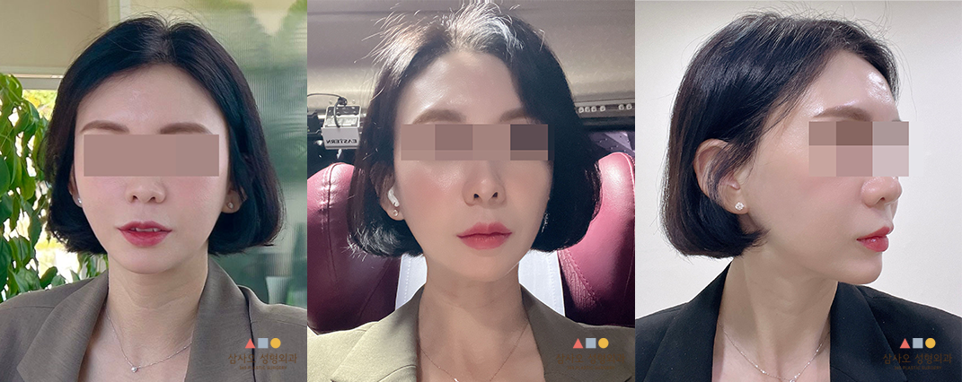 수술 후