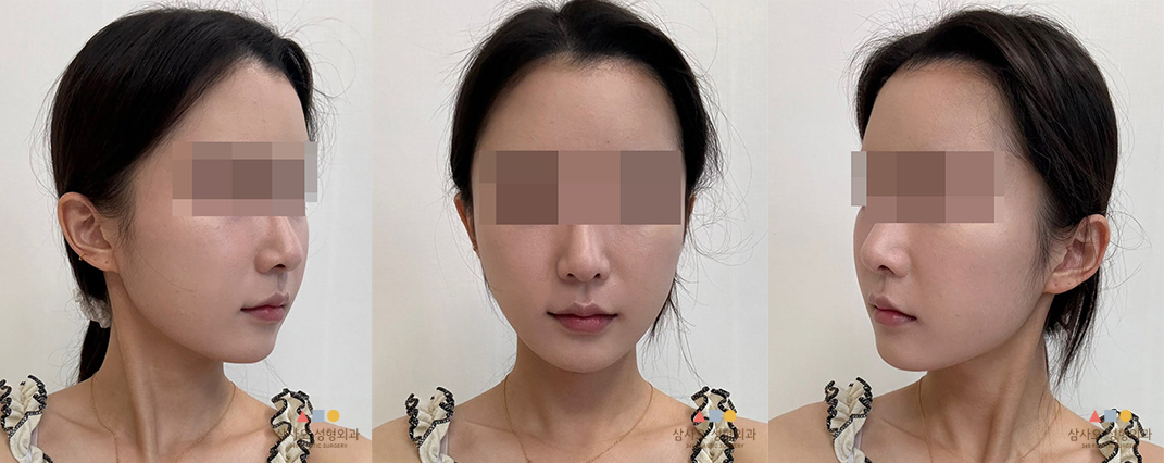 수술 후