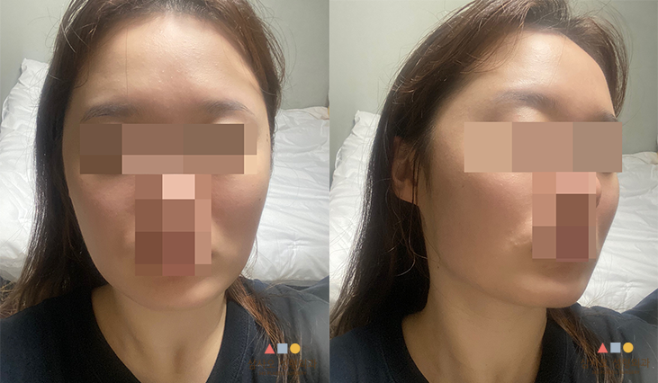 수술 전