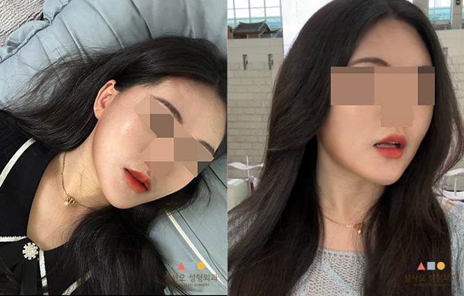 수술 후
