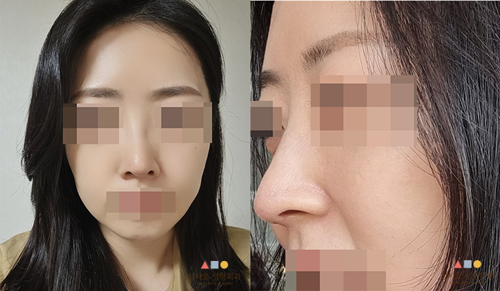 수술 후