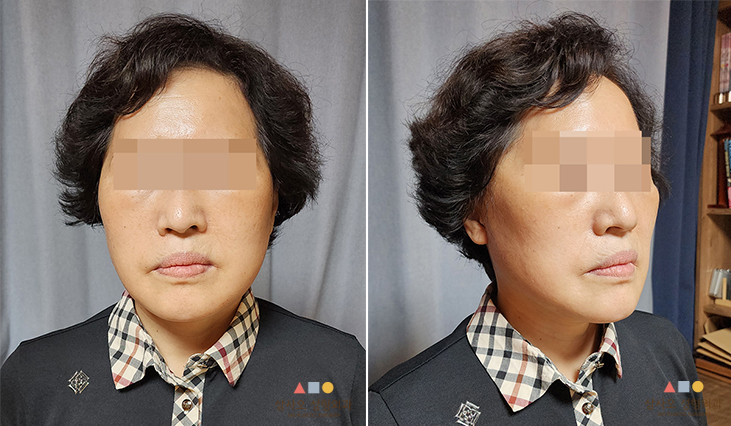 수술 후