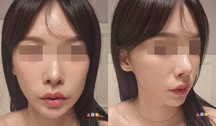 수술 후 
