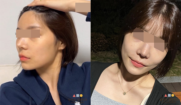 수술 전